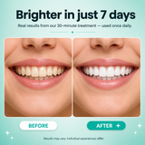 BrightSmile Whitening Strips – Professional-Grade, 30 Min Results